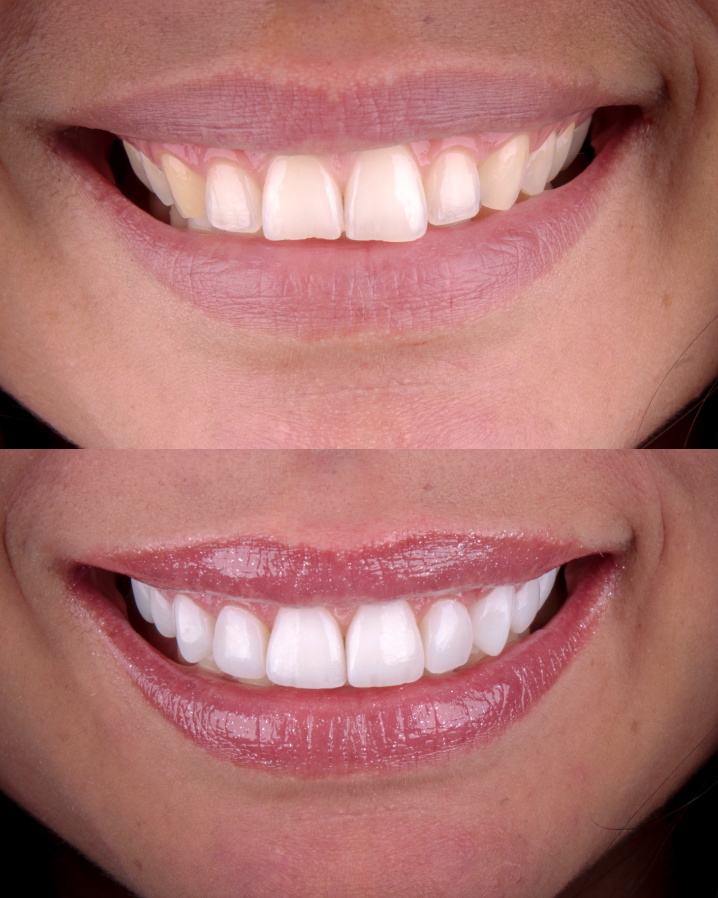Antes e depois — sorriso 5