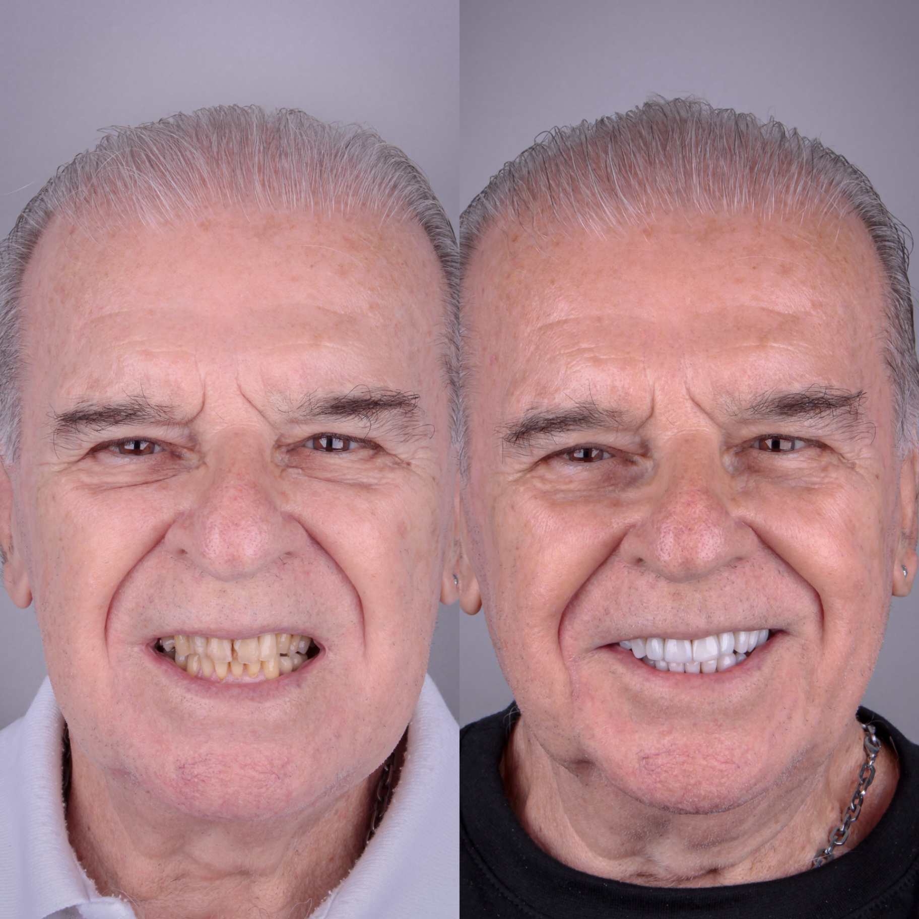 Antes e depois — caso 4