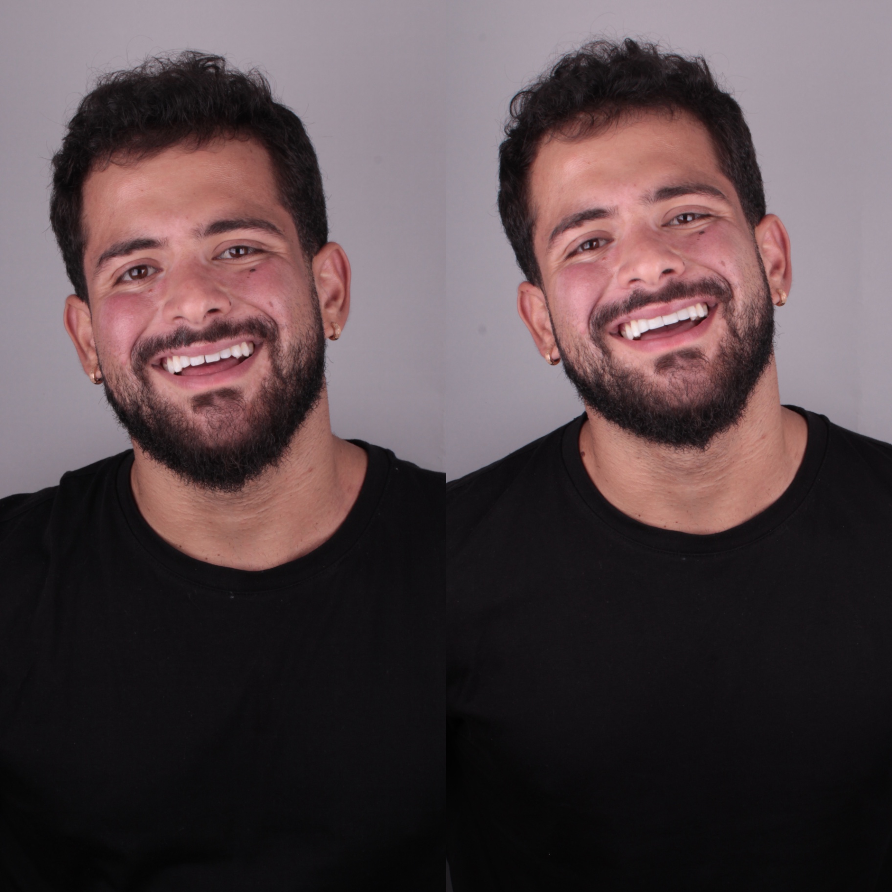 Antes e depois — rosto 5