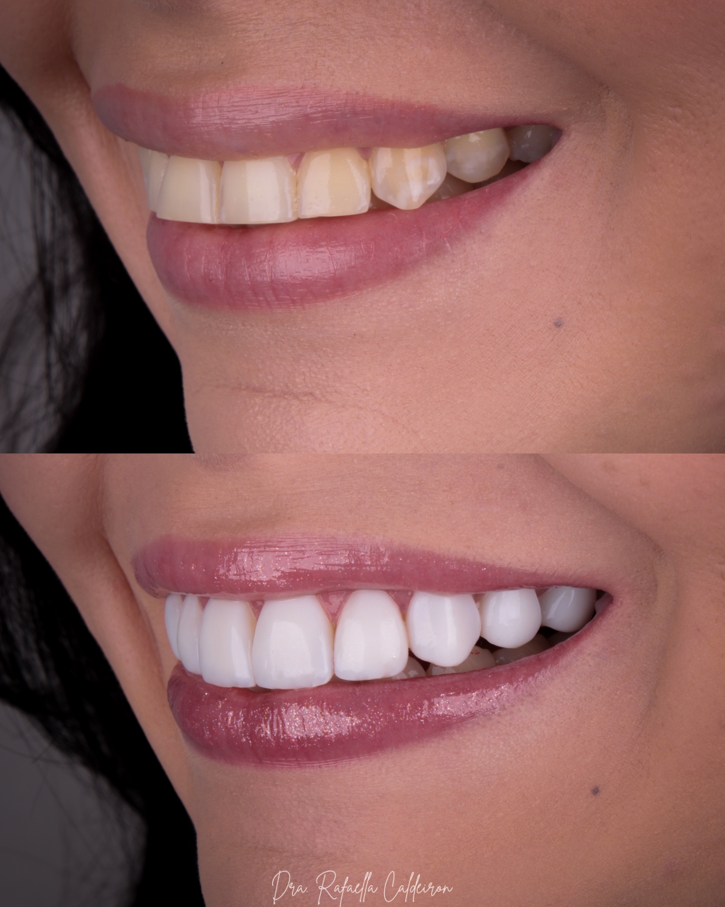 Antes e depois — sorriso 4