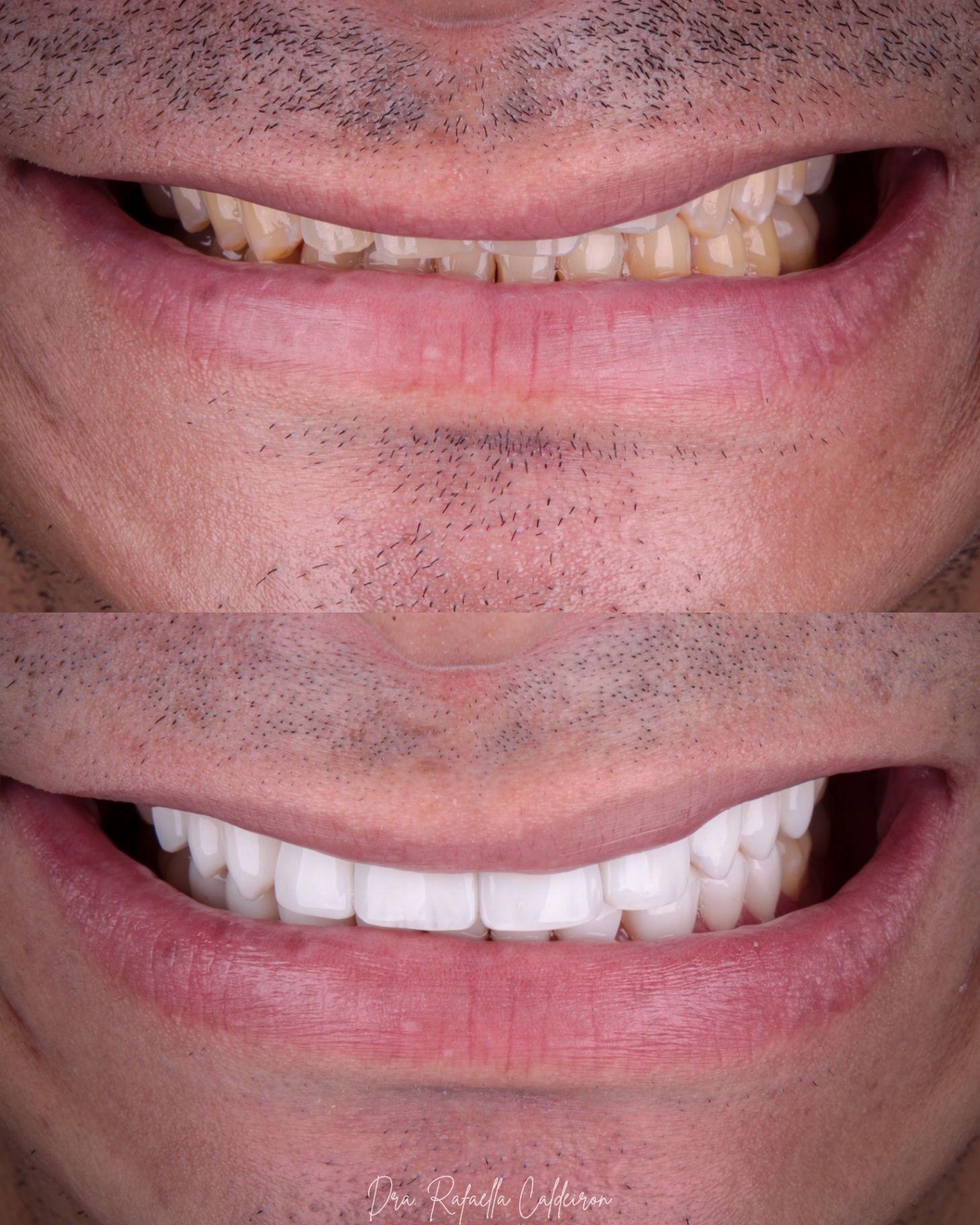 Antes e depois — sorriso 3