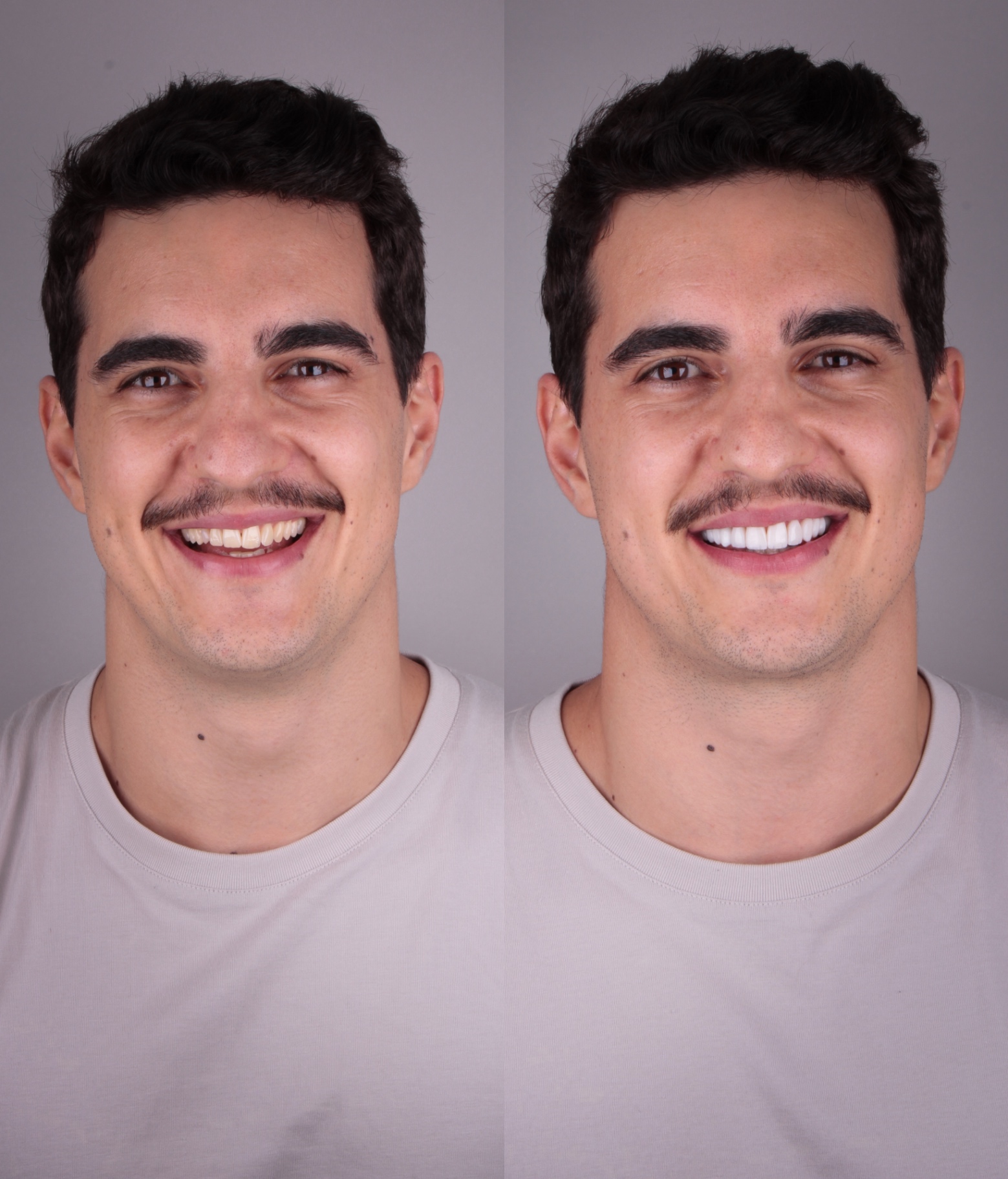 Antes e depois — rosto 2