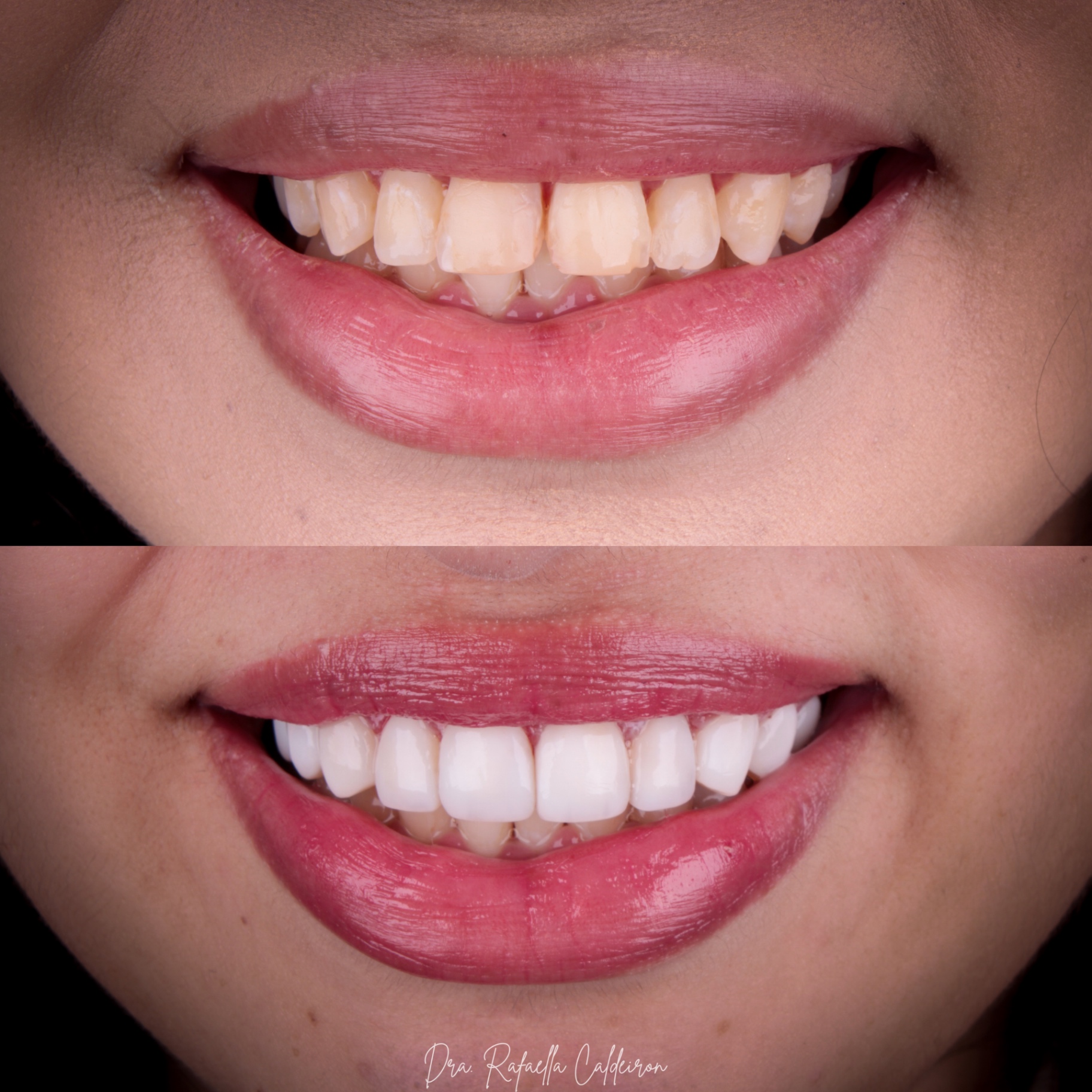 Antes e depois — sorriso 2