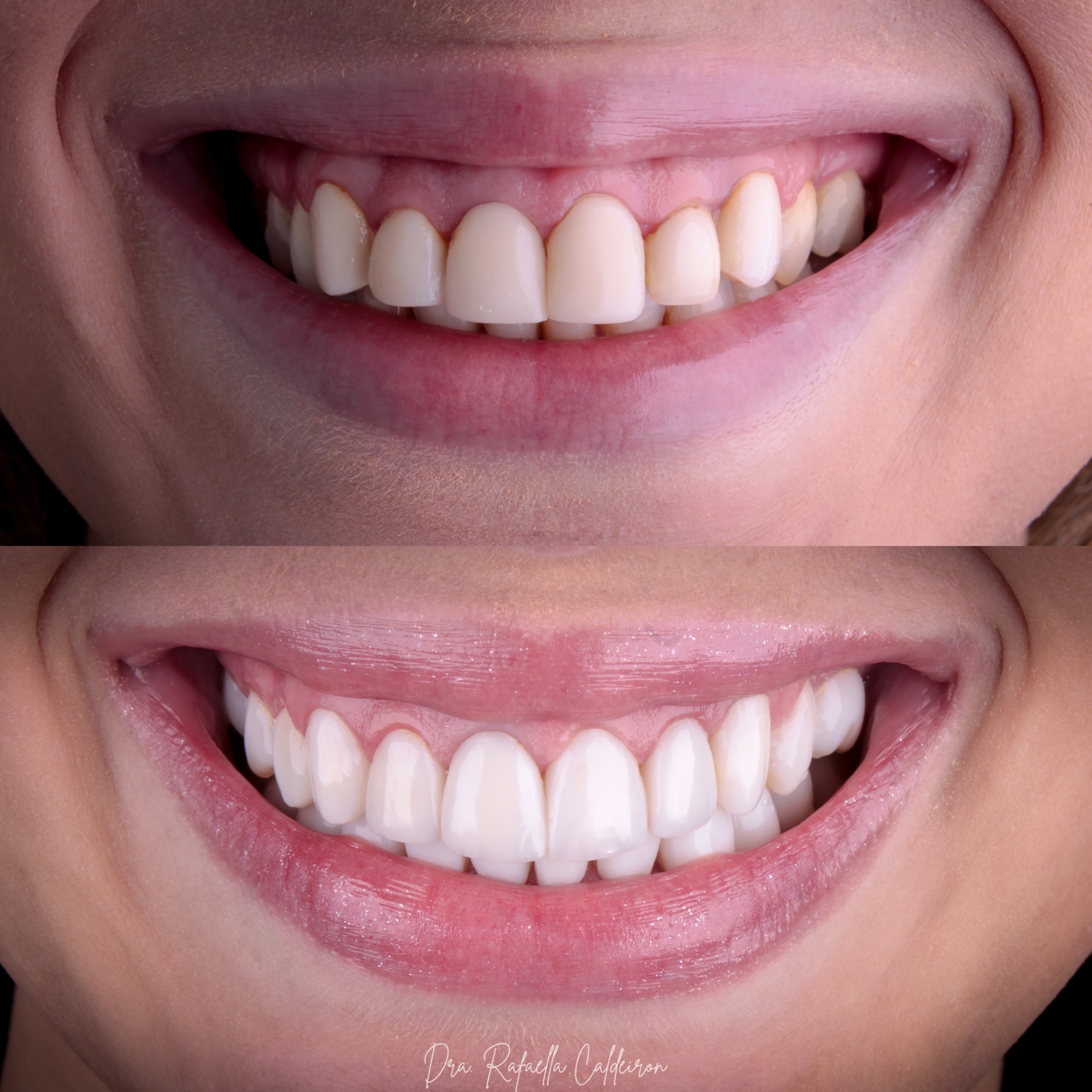 Antes e depois — sorriso 1