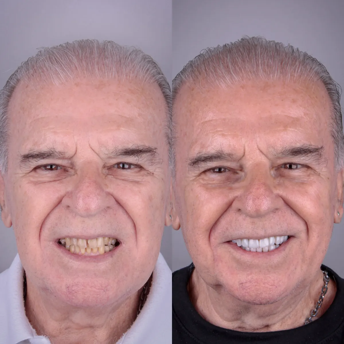Antes e depois — caso 4