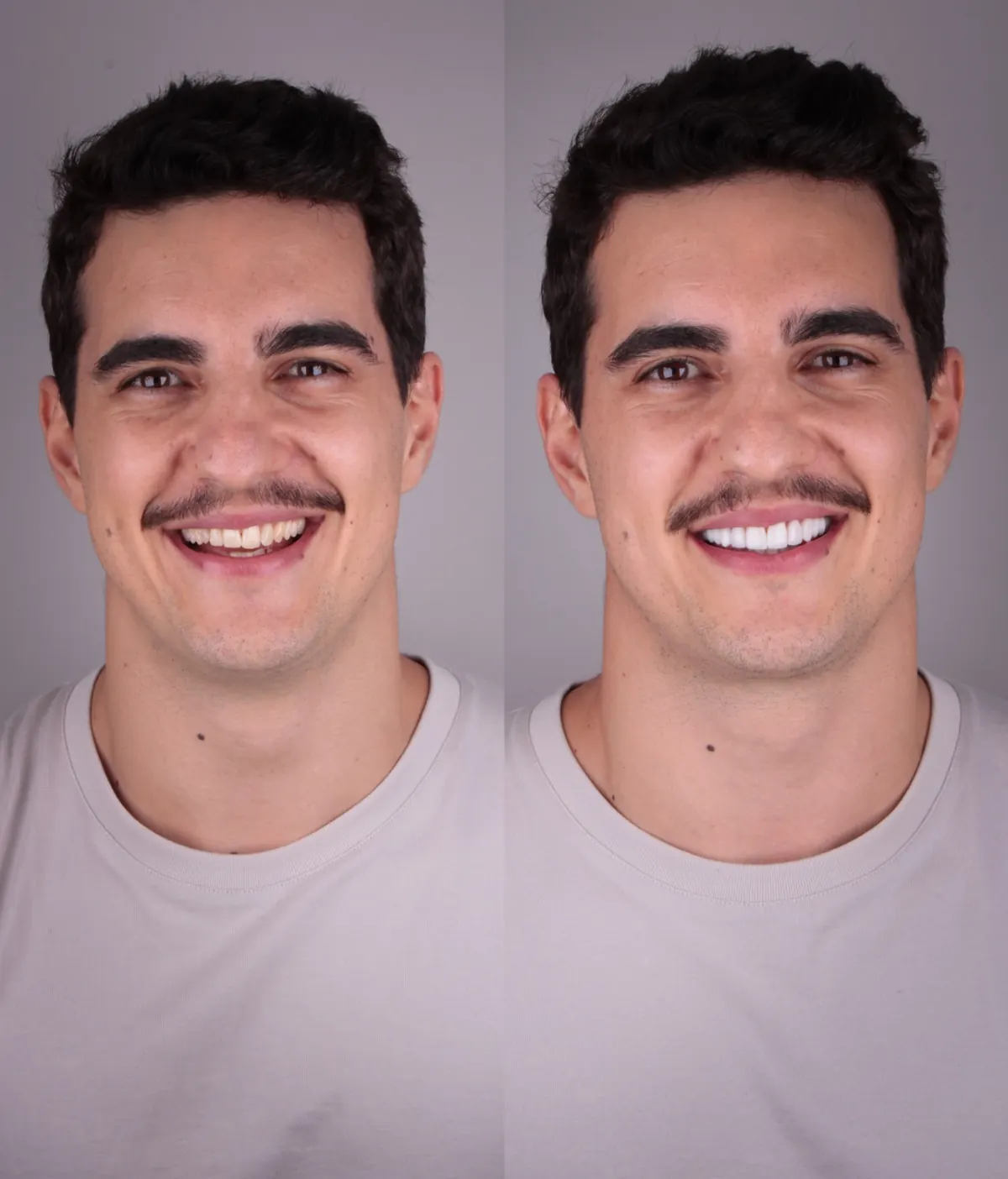 Antes e depois — rosto 2