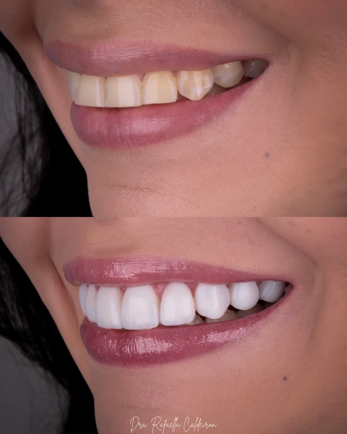 Antes e depois — sorriso 4